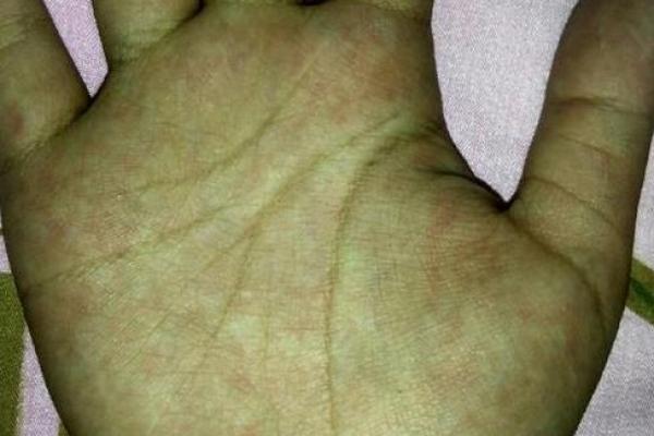 左耳畸形命理解析:命运不同,如何改运? 左耳畸形命理解析:命运不同,如何改运?