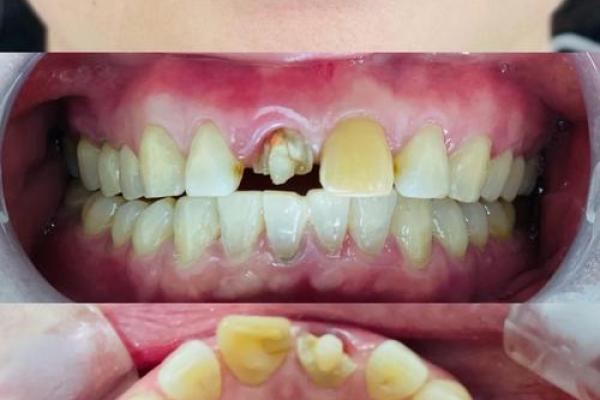 解析牙齿外伤与命运的关系:合婚时如何看待这一点? 解析牙齿外伤与命运的关系:合婚时如何看待这一点?